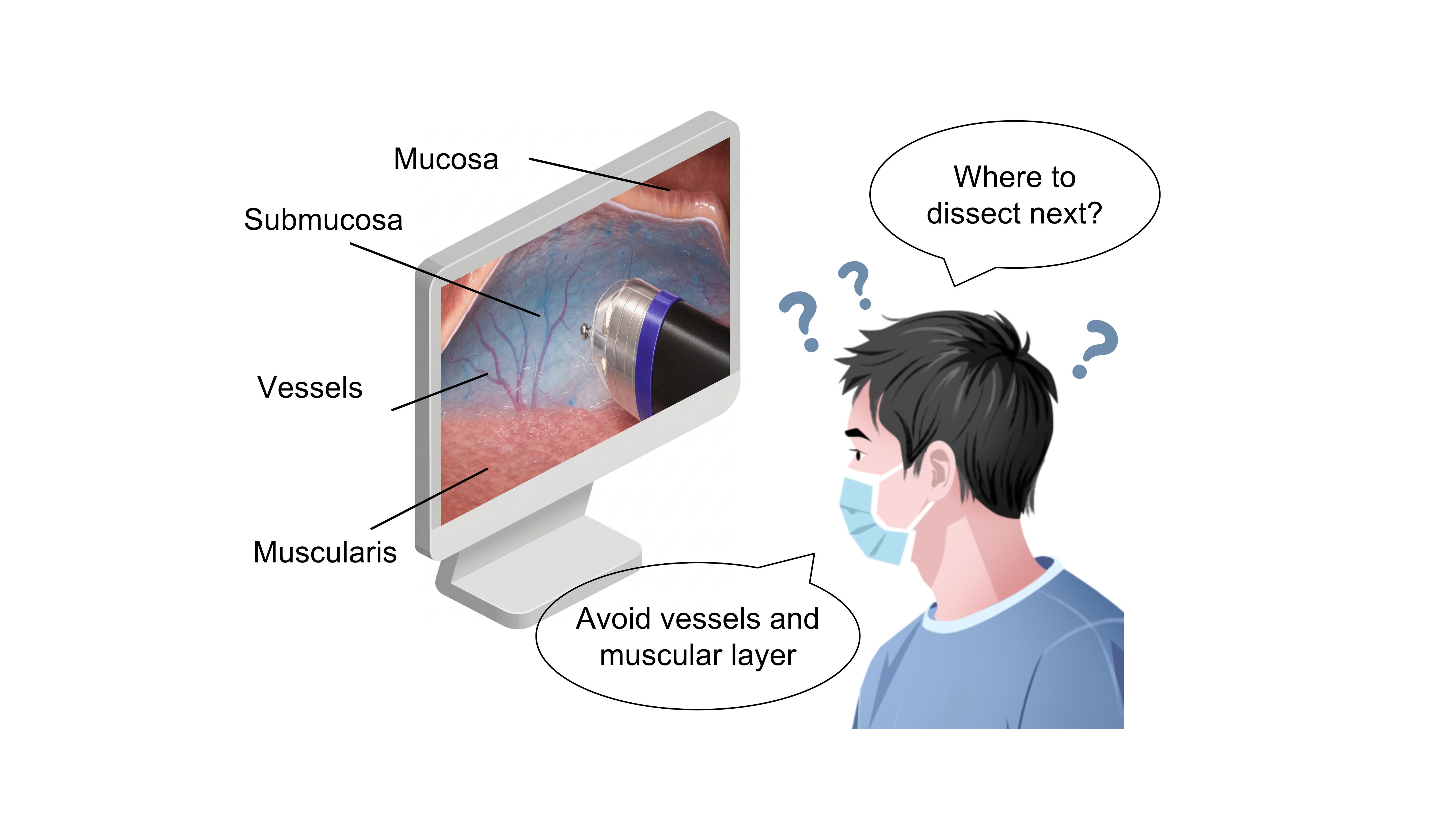 A surgeon asks where to dissect next while identifying the mucosa, submucosa, vessels and muscularis, aiming to avoid vessels and the muscular layer.