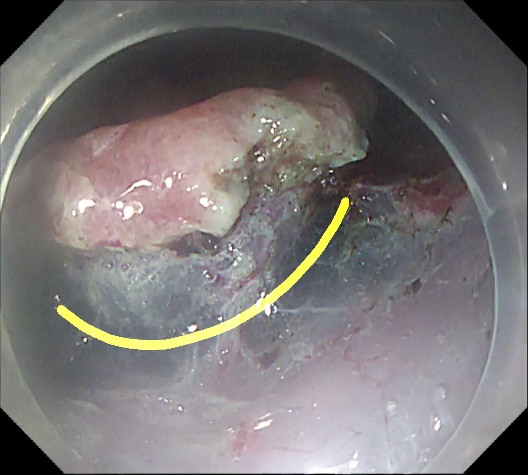 The same endoscopic frame with the AIONS-predicted dissection trajectory in yellow